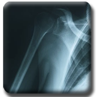 Shoulder X-ray